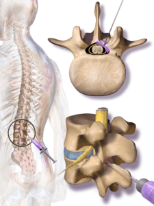 Spinal injections - Jamie